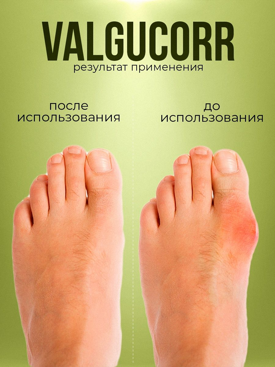 Valgucorr отзывы