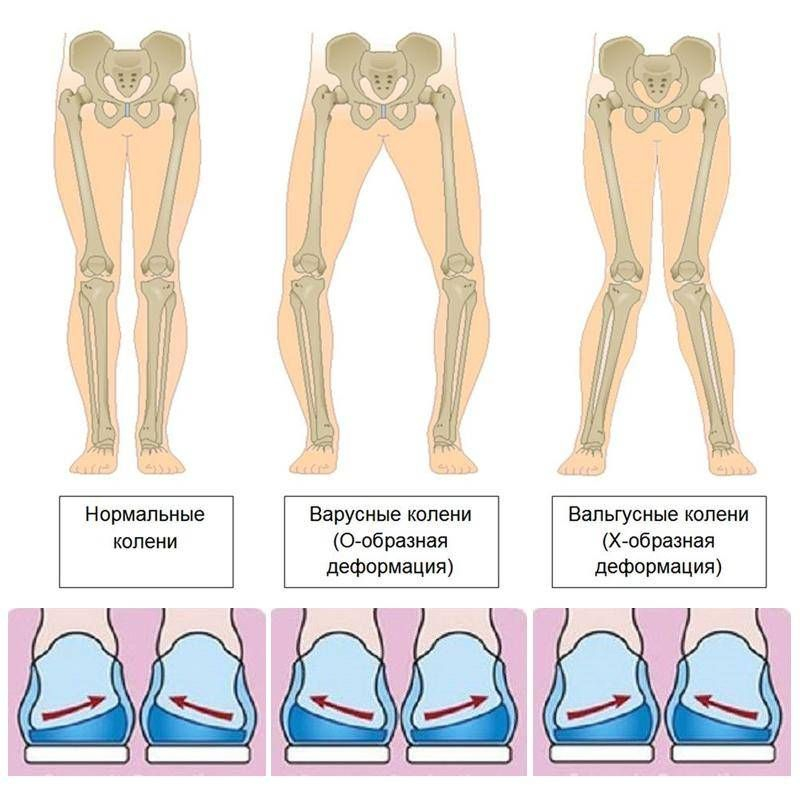 Вальгус и варус фото